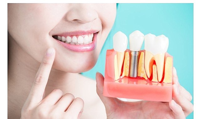 Diş İmplantları Hakkında Bilmeniz Gereken 9 Bilgi!