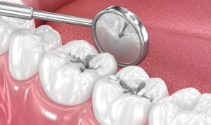 Amalgam Dolgular Değiştirilmeli mi?